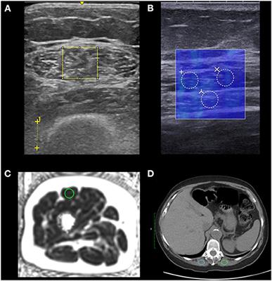 Myosteatosis as a Shared Biomarker for Sarcopenia and Cachexia Using MRI and Ultrasound